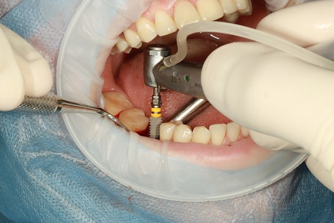Dentist implanting a dental implant