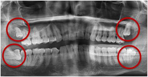 Panorama x-ray with four impacted wisdom teeth