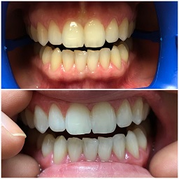 A glowing new smile after the bleaching