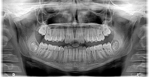 Panorama x-ray of a patient's oral cavity in an orthodontist office