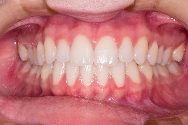 Healthy teeth after a periodontitis treatment