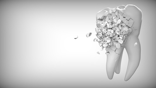 A broken tooth causing the need for a dental implant
