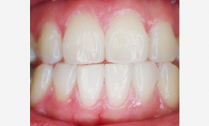 Healthy teeth and gums without gum recession